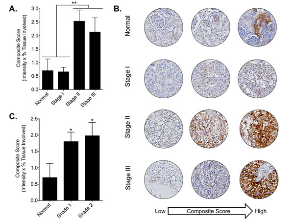 DCLK1 protein is overexpressed in RCC tumor tissue.