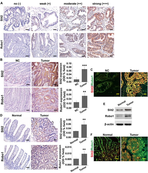 Expression of Slit2 and Robo1 in intestinal tumors.