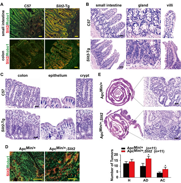 Activation of Slit2/Robo1 signaling accelerates the progression of intestinal tumors.