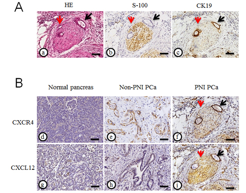 Fig.2: Expression of CXCR4 and CXCL12 in pancreatic cancer tissues.