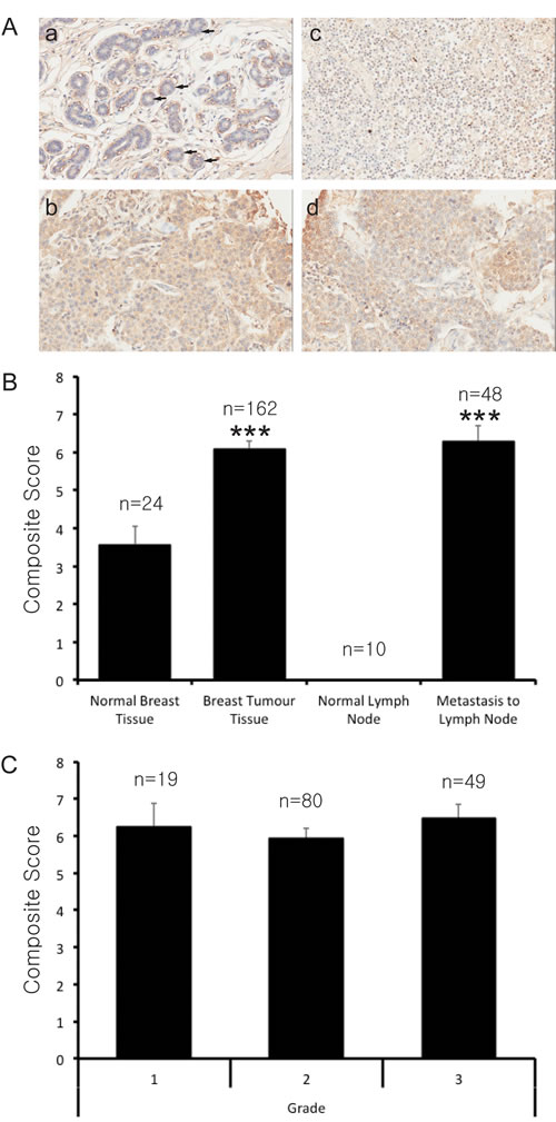 PRMT7 is overexpressed in breast cancer tissues.
