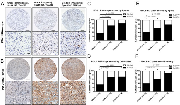 PD-L1 mRNA and protein expression in meningioma by grade.