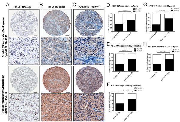 PD-L1 mRNA and protein expression in meningioma by grade in validation cohort.