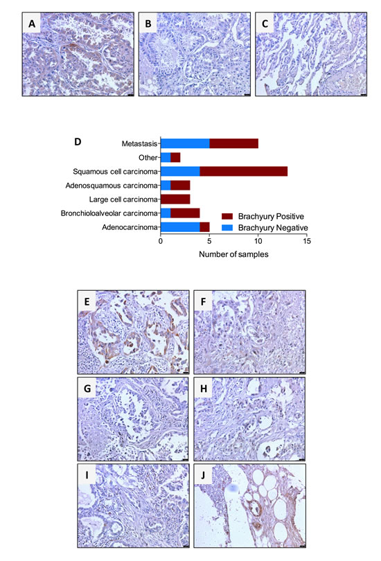Immunohistochemical detection of brachyury protein in human lung cancers using MAb 54-1.