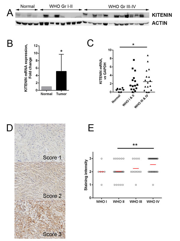 KITENIN expression in human glioma samples.