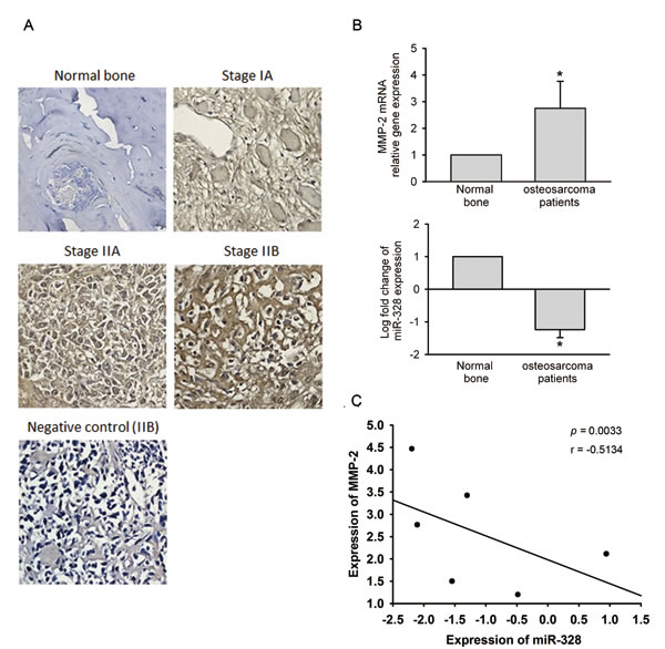 Clinical significance of matrix metalloproteinase (MMP)-2 and miR-328 in osteosarcomas.