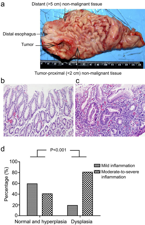 Chronic inflammation correlates with dysplasia in gastric cardia epithelia.