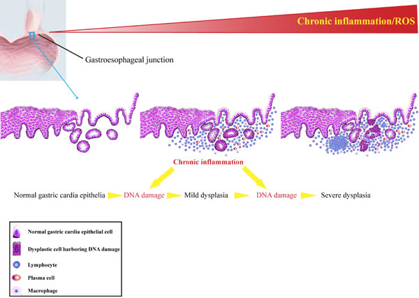 Schematic diagram of persistent chronic inflammation-related DNA damage response contributes to gastric cardia carcinogenesis.