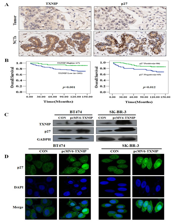 The association of TXNIP and p27 with OS in breast cancer tissues and NCTs in a tissue-array.