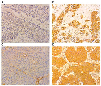 Immunohistochemical staining showing B7-H1 and B7-H3 expression in NSCLC and normal lung tissues (original magnification &times;100).