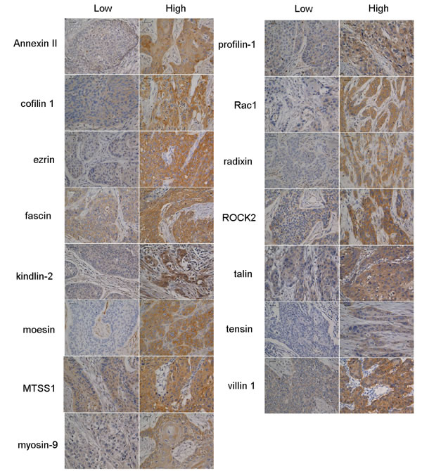 Representative positive expressions of Annexin II, cofilin 1, ezrin, fascin, kindlin-2, moesin, Metastasis suppressor 1 (MTSS1), myosin-9, profilin-1, Ras-related C3 botulinum toxin substrate 1 (Rac1), radixin, Rho-associated coiled-coil containing protein kinase 2 (ROCK2), talin, tensin and villin 1 by immunohistochemistry in tissue microarrays.