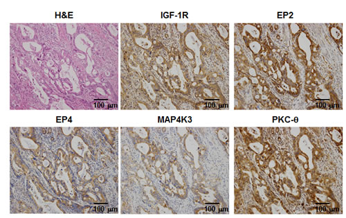 H&amp;E and immunohistochemical staining for IGF-1R, EP2, EP4, MAP4K3, and PKC-&#x3b8; in the representative case of quadruple positive.