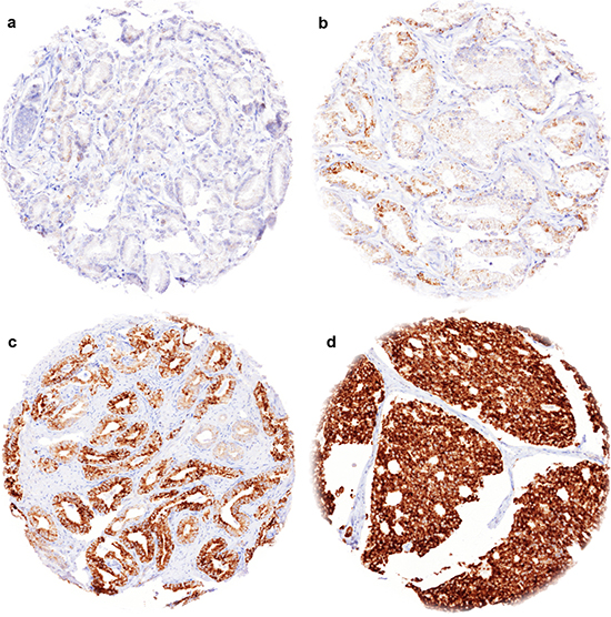 Representative images of TYMS immunostainings in prostate cancer.