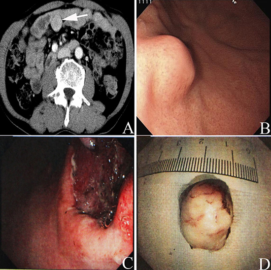Preoperative abdominal enhanced CT scan showed a mass (white arrow in A) with a size of 3.5cm&#x00D7;3 cm located in the abdominal cavity in one patient with rectal cancer.
