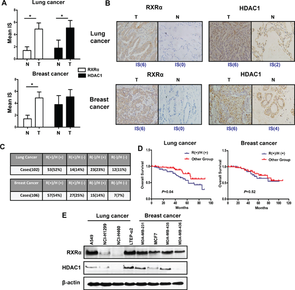 RXR&#x03B1; and HDAC1 are highly expressed in human breast and lung cancer tissues and cell lines.
