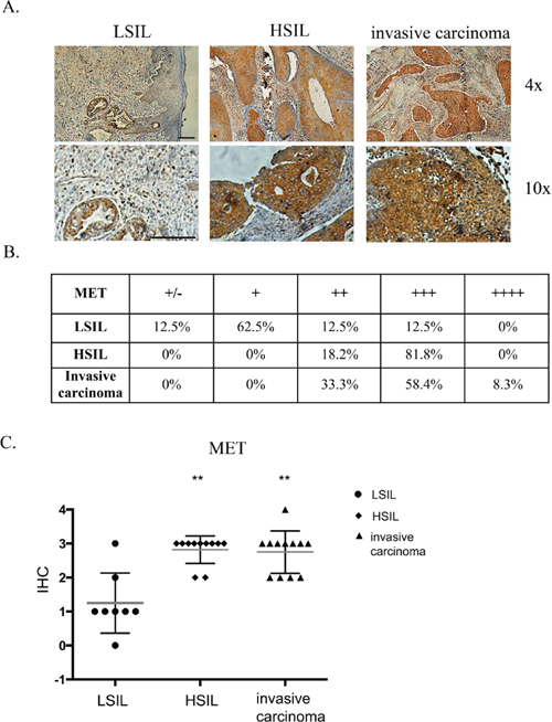 Immunohistochemical analysis of MET receptor expression in patient samples.