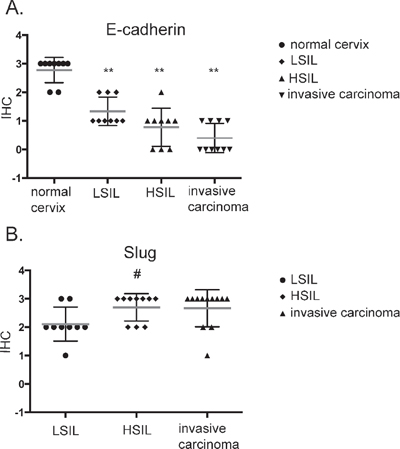 Immunohistochemical analysis of E-cadherin (A) and Slug (B) expression in patient samples.