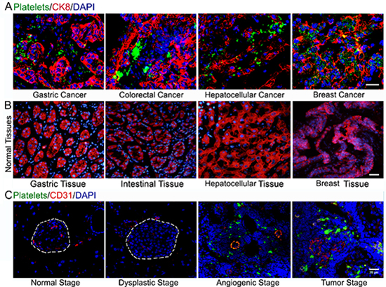 Platelets accumulate in human carcinomas and insulinoma.