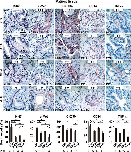 Aspirin intake before surgery inhibits the expression of progression markers in PDA patient tissue.