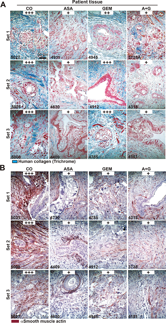 Aspirin intake before surgery reduces desmoplasia in patient tissues.