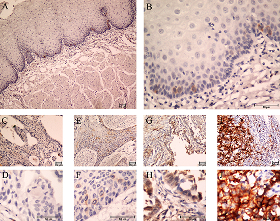 Expression of TACC3 in ESCC tissues by immunohistochemistry staining.
