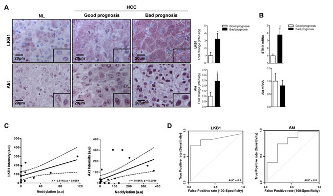 Association between LKB1, Akt and neddylation in human HCC.