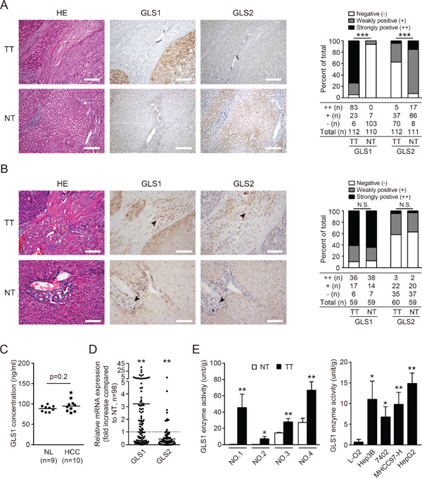 Expression and biodistribution of GLS1 and GLS2 in hepatocellular carcinoma.