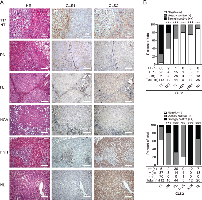 Expression and biodistribution of GLS1 and GLS2 in HCC and other liver diseases.