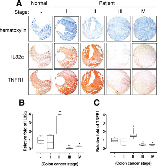Relationship between IL-32&#x03B1; and TNFR1 in human colon cancer patients.