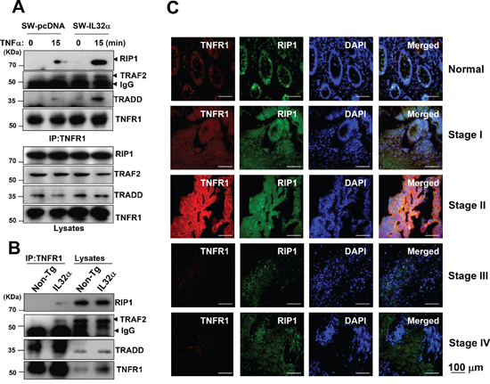 Effect of IL-32&#x03B1; on TNFR1-adaptor complex in colon cancer development.