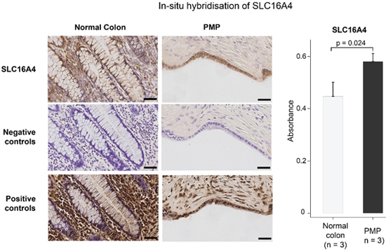 In-situ hybridization staining for gene expression of up-regulated gene, SLC16A4, in normal colon and disseminated PMP, with positive and negative control probes.