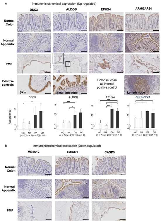 Immuno-histochemical staining for protein product expression of (A) up-regulated genes (DSC3, ALDOB, EPHX4, ARHGAP24) and (B) down-regulated genes (MS4A12, TMIGD1, CASP5) in normal colon (NC) and normal appendiceal (NA) mucosa, diseased appendix (DA), and disseminated disease (DD), with positive and negative controls.