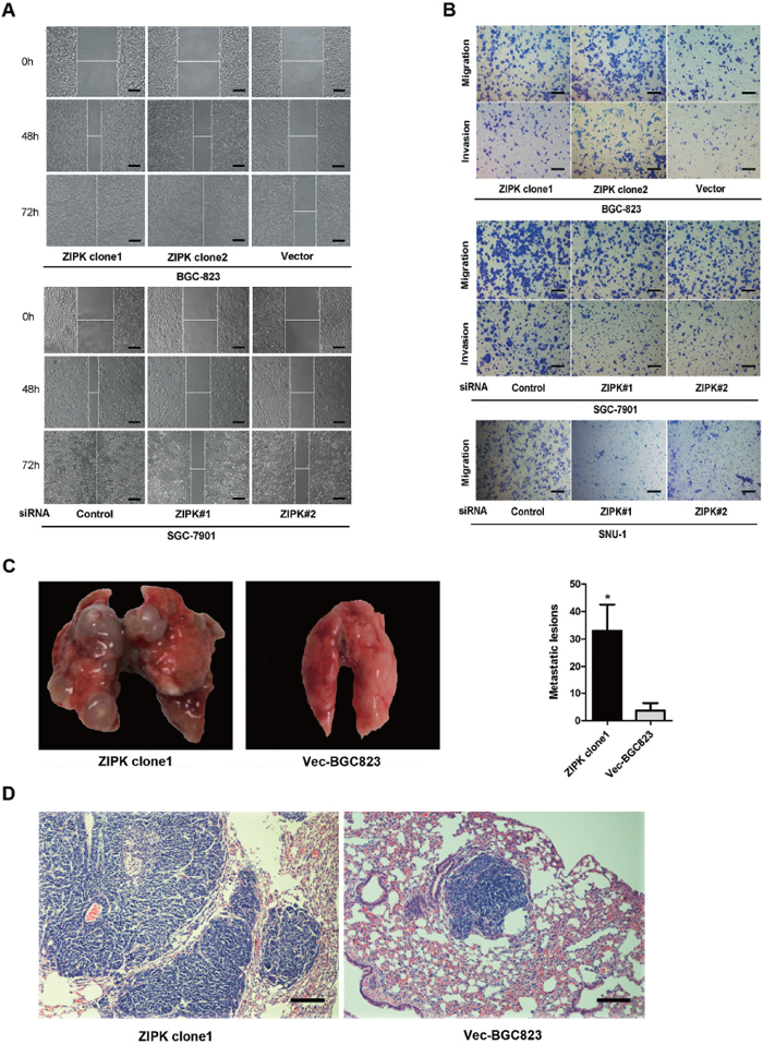ZIPK promotes cell invasion and gastric cancer metastasis.