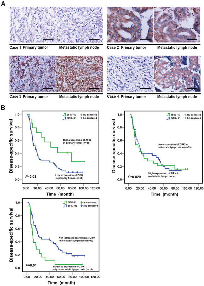 The prognostic significance of ZIPK expression in primary GCs and matched metastatic lymph nodes.