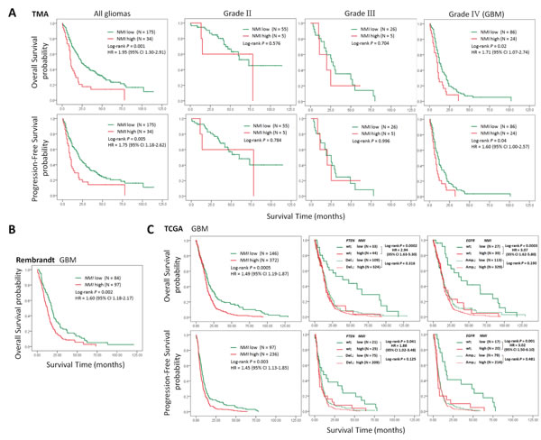 High expression of NMI predicts a poor clinical outcome in human gliomas.