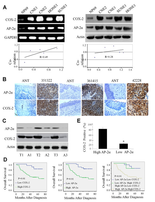 High expression of AP-2&#x3b1; and COX-2 in NPC cells and tumor tissues.