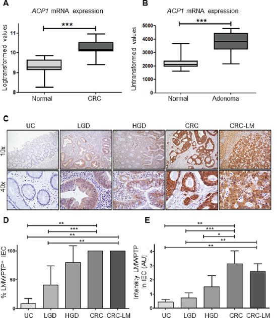 ACP1 mRNA and LMWPTP protein expression are increased in colorectal dysplasia and carcinoma as compared to non-dysplastic tissue.
