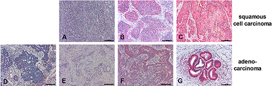 Expression patterns of RIPK3 in SCC or adenocarcinoma.