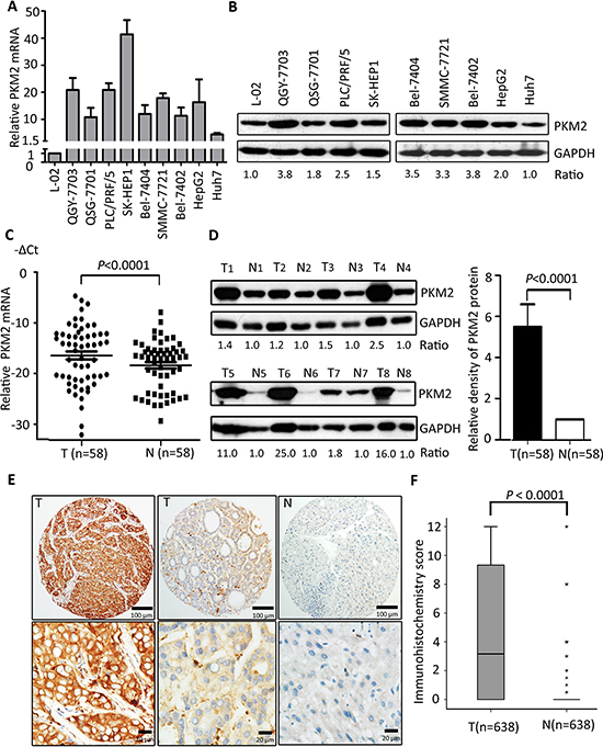 PKM2 is overexpressed in HCC cell lines and tissues.