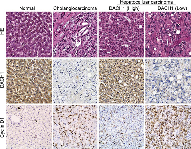 Immunohistochemistry analysis of DACH1 and cyclin D1 on HCC tissues.