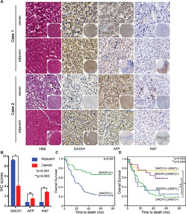 DACH1 is an independent prognostic factor of overall survival in HCC patients.