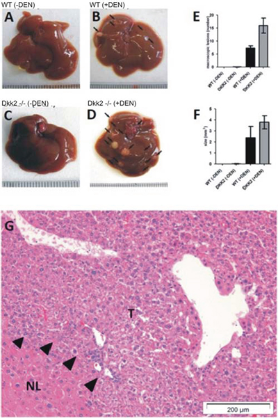 A-D. Tumor development in Dkk2&#x2212;/&#x2212; knock out and wild type (WT) animals demonstrated a significantly increased tumor development in diethylnitrosamine (DEN) treated Dkk2&#x2212;/&#x2212; compared to WT animals.