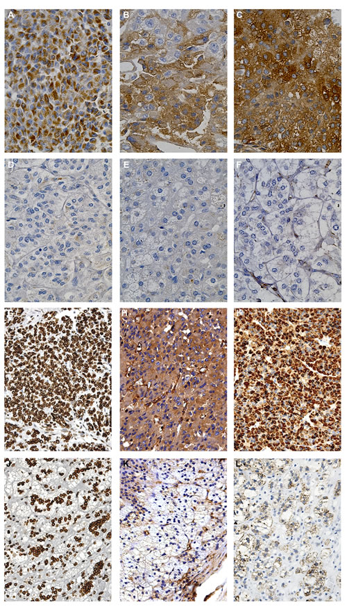 Fig.5: Immunohistochemical detection of the six proteins differentially expressed in ACC and normal adrenal.