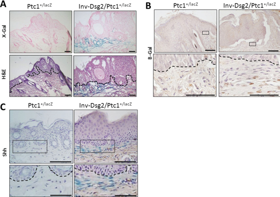 Inv-Dsg2/Ptc1+/lacZ mice display Hh activity in the tumor stroma.