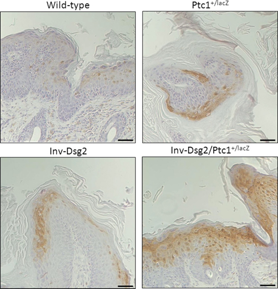 Inv-Dsg2/Ptc1+/lacZ squamous lesions exhibit enhanced activation of Phospho-Erk1/2.