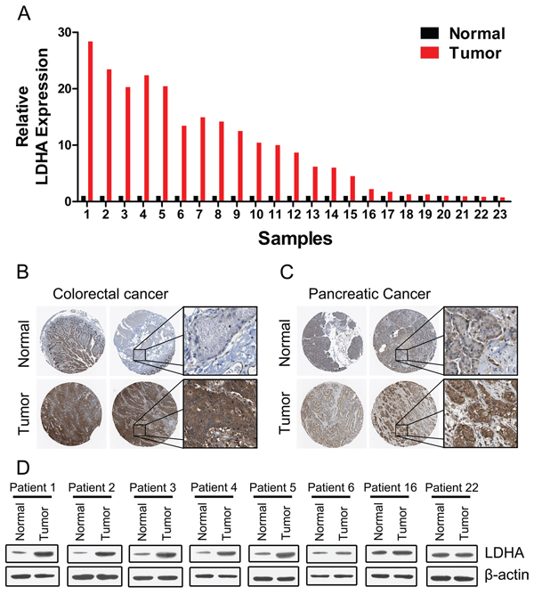 Expression of LDHA in human colorectal cancer and pancreatic cancer tissues.