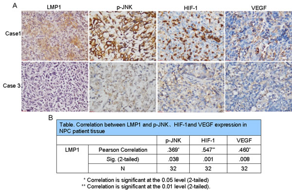 LMP1 up-regulates p-JNK, HIF-1 and VEGF expression in NPC patient tissues.