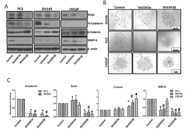 GSK3&#x3b2; predominantly regulates prostate cancer epithelial-to-mesenchymal transition via a Snail/N-Cadherin/&#x3b2;-Cateinin pathway.