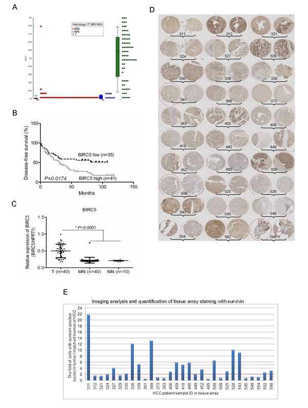 Fig.1: The remarkable heterogeneous expression of survivin in HCC tissues.