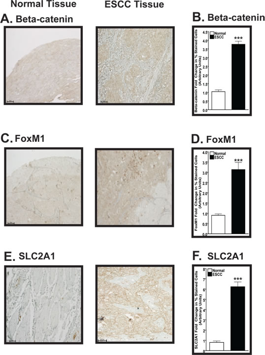 Expression of &#x3b2;-catenin, FoxM1, and SLC2A1 is increased in human ESCC compared to normal esophageal tissue.